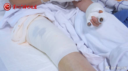 皇冠信用网注册_女子水中捡漂亮石头装裤兜里被烧伤皇冠信用网注册，医生：“石头”初步判定是磷