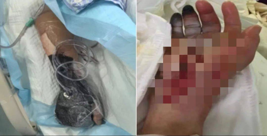 皇冠会员如何申请_戴手套！戴手套！死亡率近100%皇冠会员如何申请，浙江已有人中招